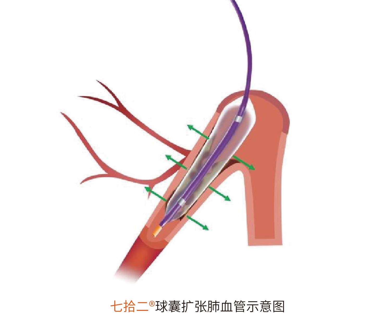 七拾二®Sev-changes 肺动脉球囊扩张导管(图2)